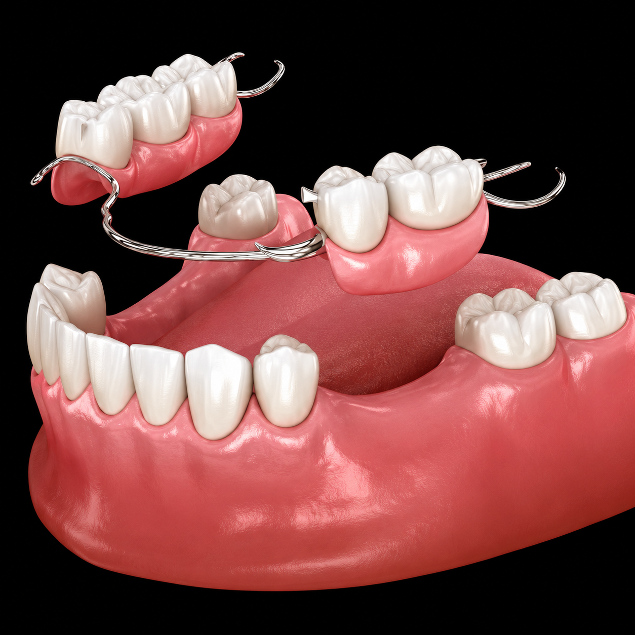 Dentures and Partials